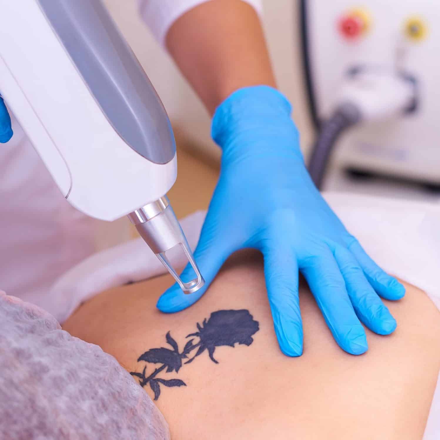 tattoo-removal | Tenth Avenue Aesthetics