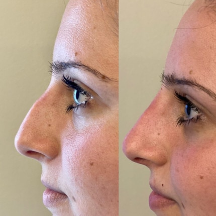 Liquid Nose Job