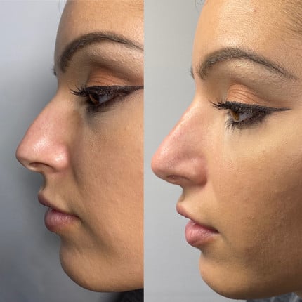 Liquid Nose Job