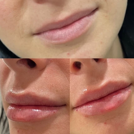 Lip Filler