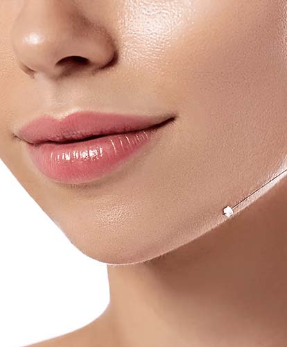 PDO Threadlift